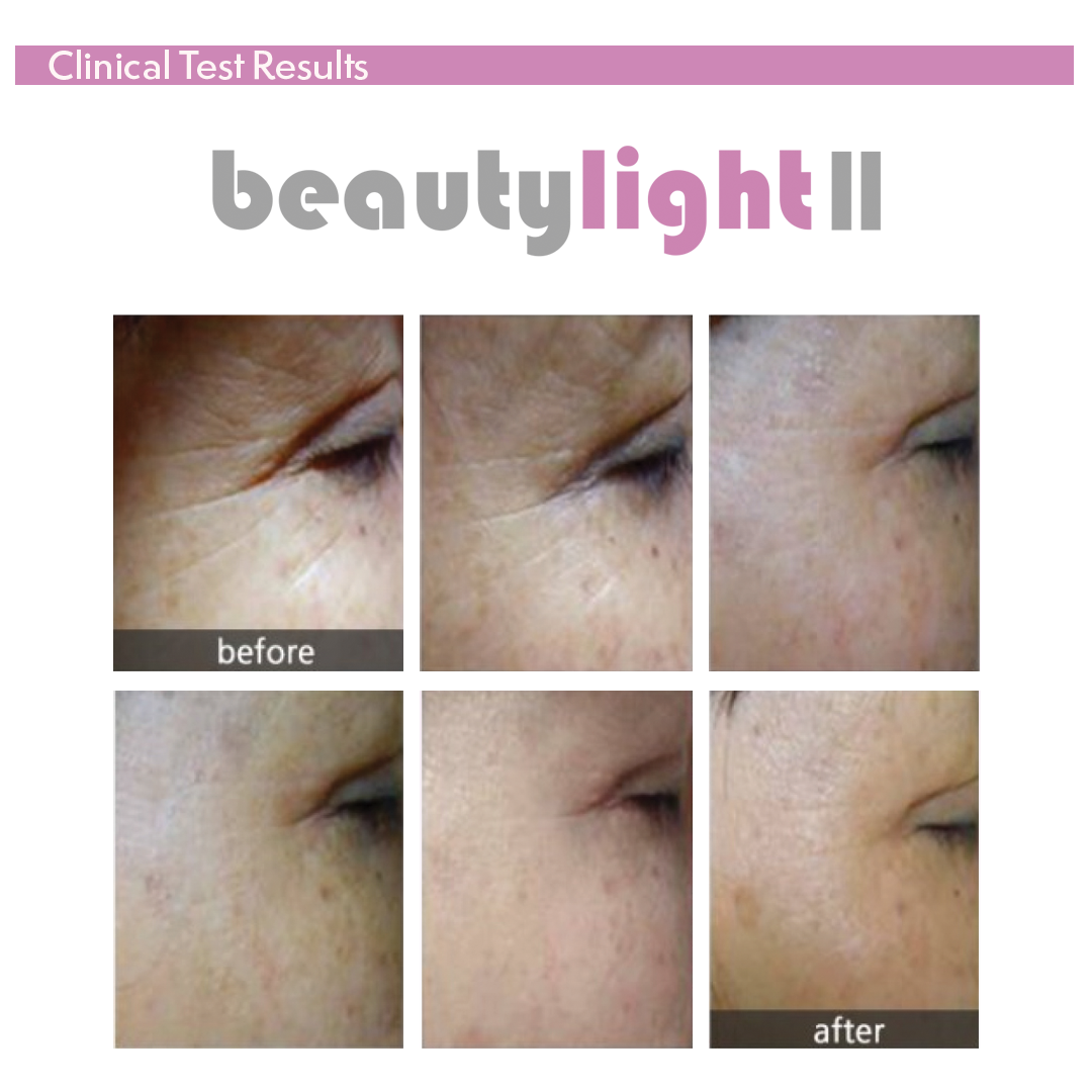 Beautylight II Photo Dynamic Thermo Therapy - Image 6