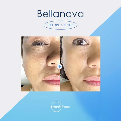 Bellanova Nano Mist Therapy System