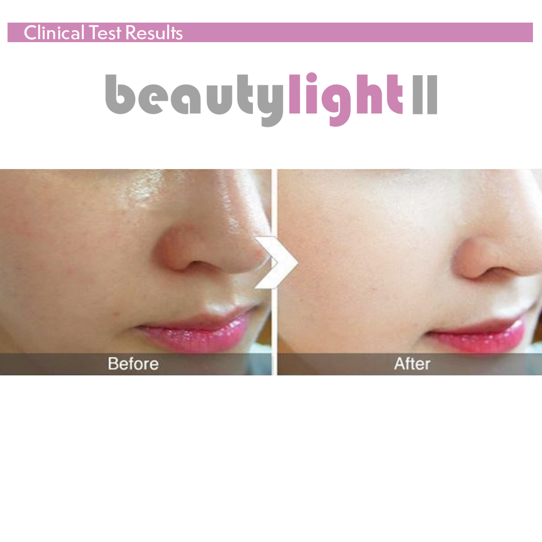 Beautylight II Photo Dynamic Thermo Therapy - Image 5